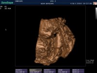 Ecografie 4D Ecografie 4D